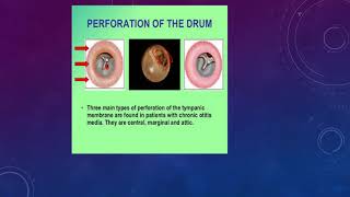 Tympanic membrane perforation [upl. by Eigram328]