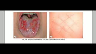 behcet disease [upl. by Kezer]