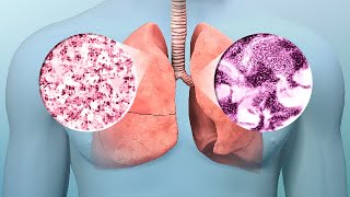 Lung Cancer Early Diagnosis Treatment [upl. by Ymmik]