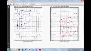 Automated Diplopia Charting [upl. by Firestone]