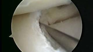 Meniscus cyst decompression [upl. by Narot]