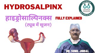 Hydrosalpinx हाइड्रोसाल्पिनक्स ट्यूब में सूजन [upl. by Simonne]