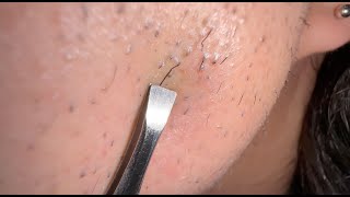 ASMR 4K，Macro Photography 拔出胡子 Extractions Hair Tweezers Beard [upl. by Brod]