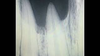 PERIAPICAL CYST ENUCLEATION  APICOECTOMY AT SMILE GALLERIA [upl. by Awahsoj184]