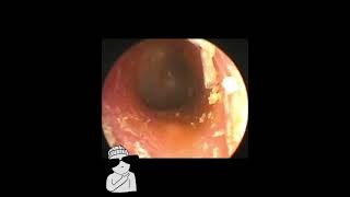 mpacted Ear Wax Removal  NN Ear cleaning earwax earwaxremoval 耳かき 耳掃除 耳掃除 [upl. by Recor]