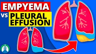 Empyema vs Pleural Effusion EXPLAINED [upl. by Alah]