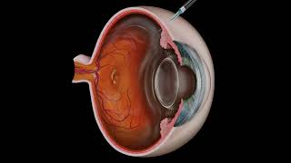 Intravitreal Eye Injection for Macular Degeneration [upl. by Ilrebma]