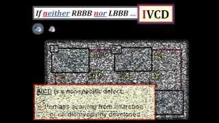 ECG Video2 Blog 96  BBB 83012014 [upl. by Coster]