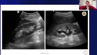 Hydronephrosis vs Normal Kidney [upl. by Auop]