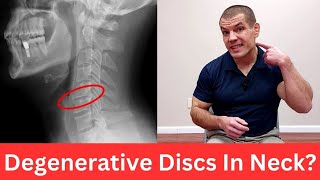 3 Exercises For Cervical Degenerative Disc Disease Relieve Neck Pain [upl. by Pinkerton]