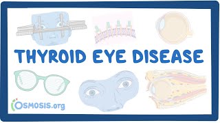 Thyroid Eye Disease causes symptoms diagnosis treatment pathology [upl. by Sito]