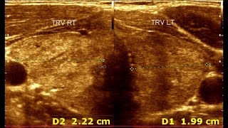 Understanding Ultrasonographic Features of Chronic Thyroiditis [upl. by Yelrahs]