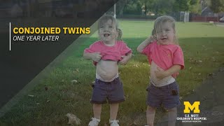 Formerly conjoined twins thriving as toddlers [upl. by Oznerol]