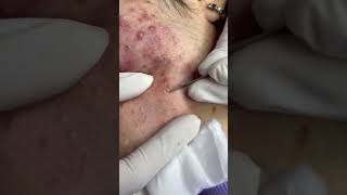 Best Pimple Popping 08 beautiful blackheads sacdepspa [upl. by Fernald565]