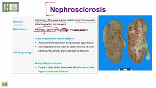 تصلب الكلية  Nephrosclerosis [upl. by Wolford]