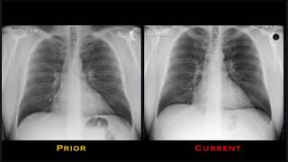 Pneumonia Explained by Prometheus Lionhart MD [upl. by Villada]