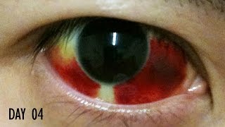 27 Days Healing Time Lapse Broken Blood Vessel in Eye Subconjunctival Hemorrhage [upl. by Kindig198]