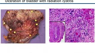 Management of RadiationInduced Hemorrhagic Cystitis [upl. by Pilloff]