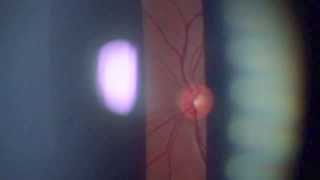 RETINAL FUNDUS 78D LENS BIOMICROSCOPY [upl. by Oleic713]