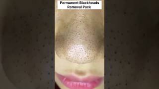 How to remove blackheads at home Permanent blackheads removal pack ytshorts viral diy shorts [upl. by Newcomb24]