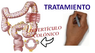 Cual es el 𝗧𝗥𝗔𝗧𝗔𝗠𝗜𝗘𝗡𝗧𝗢 de la Enfermedad Diverticular 💊 𝟭🅰 𝗣𝗮𝗿𝘁𝗲 Para Médicos [upl. by Ingalls198]