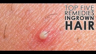 Ingrown Hair  Home Remedies for Ingrown Hairs [upl. by Brottman]