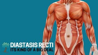 Heres Why Diastasis Recti is a Big Deal  Diastasis Ed 1 [upl. by Roby596]