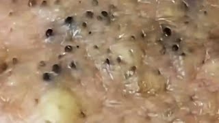 Blackheads amp Whiteheads Satisfying Removal 0082 [upl. by Nicko951]