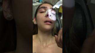 Removing a Nasal Stent 5 Days after Rhinoplasty [upl. by Devora154]