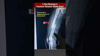 Thigh Bone Femur Fracture Xray xray radiology radiography bones Fracture radiographerusn [upl. by Maryellen]