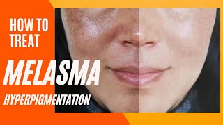 Melasma Removal at Home I Melasma Remove cream I Melasma Skin Care Regimen Routine [upl. by Weatherby]