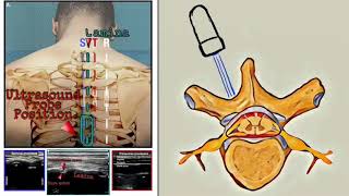 Thoracic Epidural US Assisted POCUS MOSCOW Approach УЗИ ассистированный грудной эпидуральный блок [upl. by Kiker86]