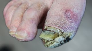 WHATS GROWING ON HIS FOOT THICK SKIN OR FUNGUS [upl. by Reneta934]