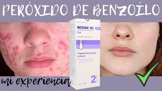 PEROXIDO DE BENZOILO✅ Como usar para el ACNE Uno de los MEJORES Tratamientos BAJO COSTO para ACNE [upl. by Zurek]