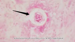 Schistosoma mansoni Ova Egg in Tissue with Haematoxylin and Eosin HampE Stain [upl. by Atinek]