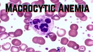 Macrocytic Anemia updated 2021  CRASH Medical Review Series [upl. by Aserat]