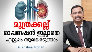 മൂത്രക്കല്ല് സർജറി ഇല്ലാതെ എളുപ്പം സുഖപ്പെടുത്താം  Kidney Stone Malayalam  RIRS [upl. by Westfall]