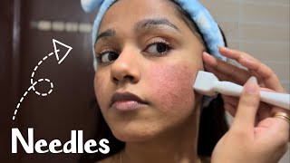 Microneedling For Acne Scars A Full Guide💉 [upl. by Brandyn]