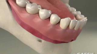 Dentures Adjust amp Reline  Roseville Dentist [upl. by Akinek]