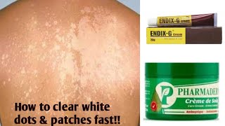 HOW TO CLEAR WHITE PATCHES OR SKIN BLEACHING DOTS IN ONE WEEK  BEST PRODUCTS FOR WHITE PATCHES [upl. by Glimp791]