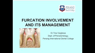 Furcation involvement amp its management [upl. by Eelorac]