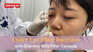 Under eye filler injection with 30G filler cannula [upl. by Dickey]