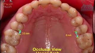 Amazing orthodontic treatment of Cl II div 2 with invisible braces  Omar 48 ys [upl. by Einiar]