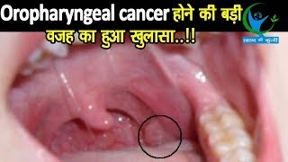 Oropharyngeal Cancer मुख और गले के कैंसर मरीजों के आंकड़ों को सुनकर दंग रह जायेंगे लक्षण और उपचार [upl. by Ennaxor]