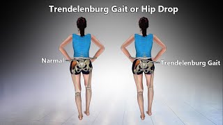 Trendelenburg Gait  Definition Causes Characteristics Diagnosis Treatment [upl. by Tomaso]