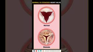 Normal vs Narrowed Stenosed Heart Valve education neet biology heart [upl. by Barolet]