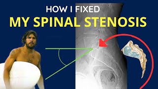 How I Reversed Spinal Stenosis without Surgery [upl. by Kaylil]