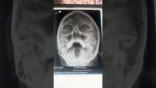 Skull x rays  Para nasal air sinus  Xray view skull [upl. by Ardelle427]