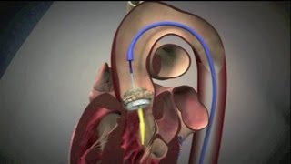 Transcatheter Aortic Valve Implantation TAVI [upl. by Harhay]