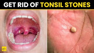 How to Prevent Tonsil Stones  Try 10 Ways  Credihealth tonsilitis tonsils [upl. by Atneuqal]